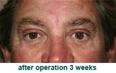 plastic-surgery-blepharoplasty